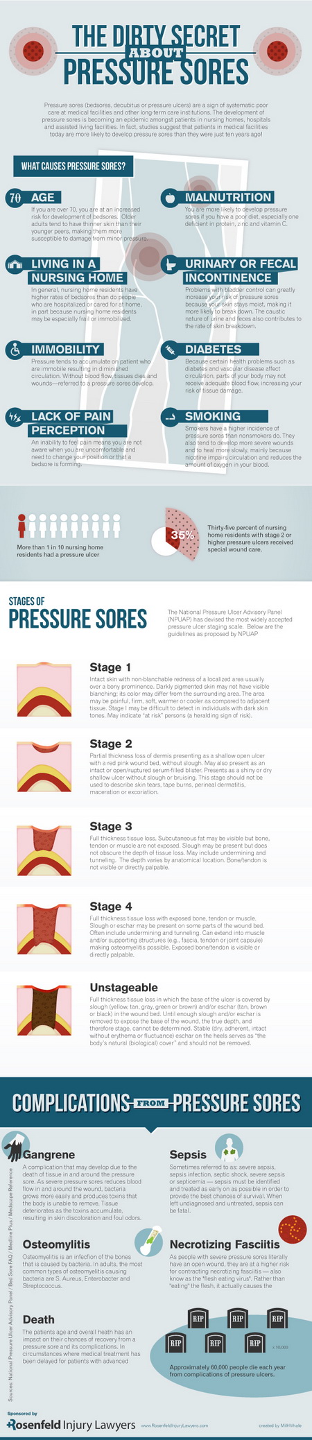 Infographic for An Infographic About Pressure Sores